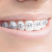 Types Of Braces