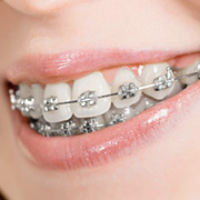 Types Of Braces