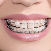 Types Of Braces