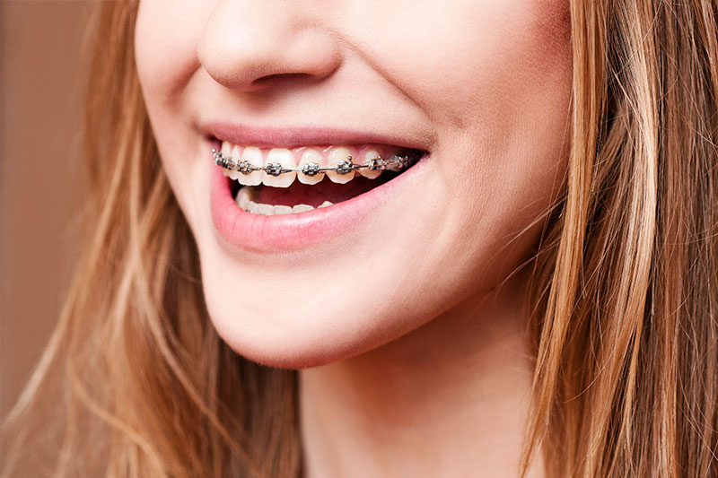 Surgical Orthodontics in Chula Vista